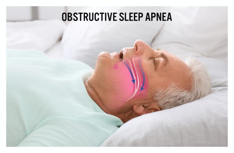 阻塞性睡眠呼吸中止症（OSA）的常見問題